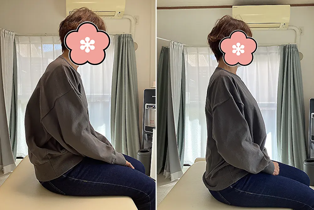 三鷹の整体院での腰痛・猫背改善ビフォーアフター